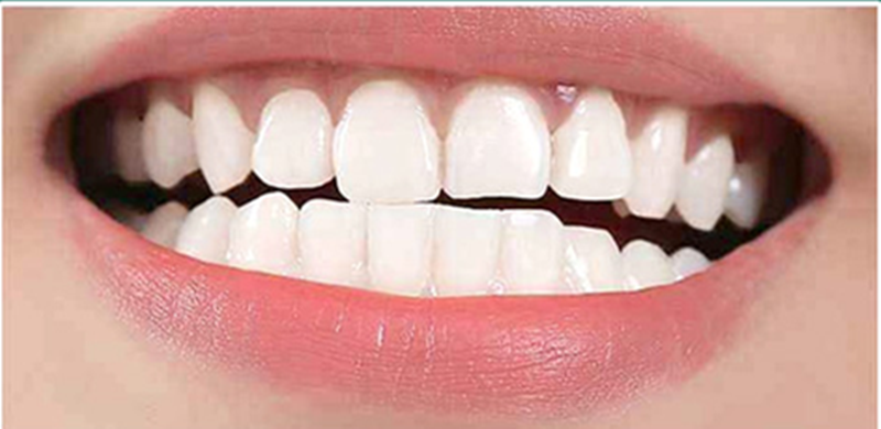 Nano-Hydroxyapatite vs Fluoride: Two Proven Approaches (Explained Simply)